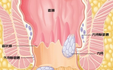 便秘和痔疮什么关系？难舍难分！