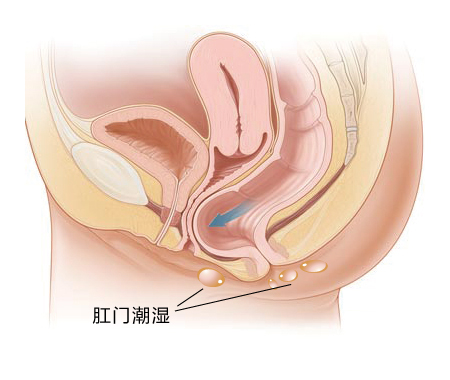 为啥“菊花”总是湿湿的？原因原来是这样...