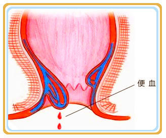 便血别老赖“痔疮”！