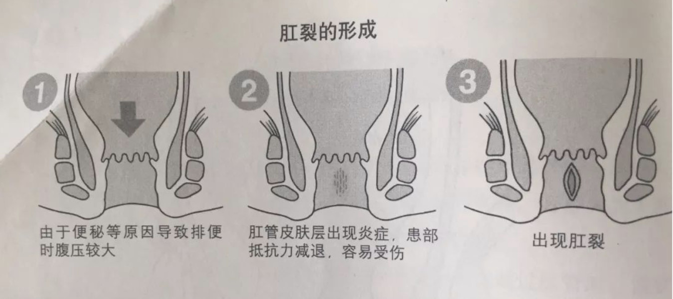 关于肛裂的知识点，看这一篇就够了！