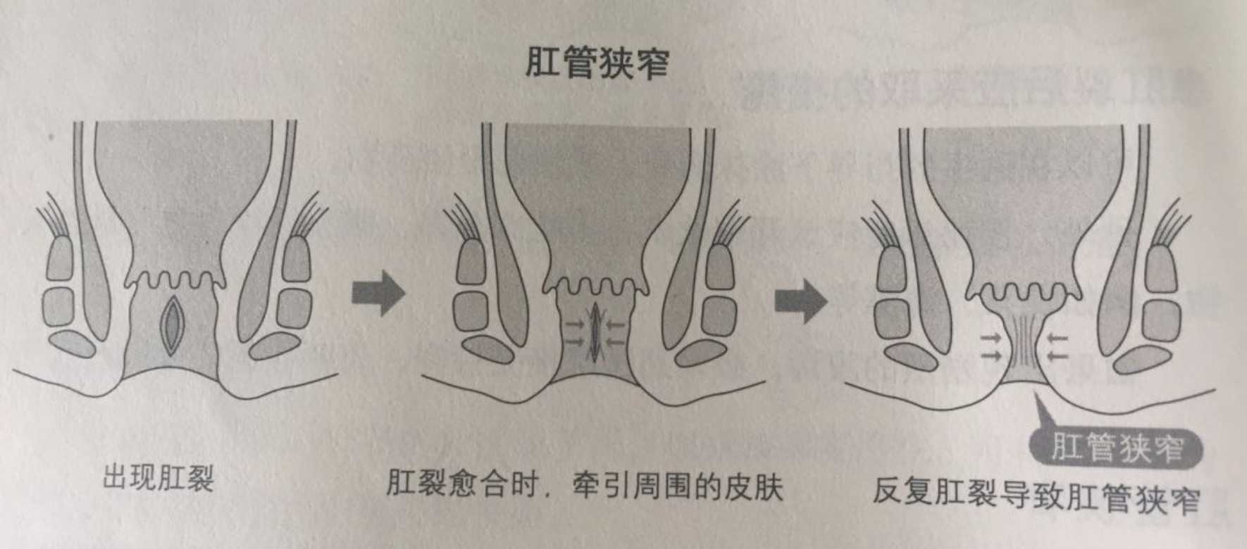 关于肛裂的知识点，看这一篇就够了！