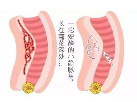 春节拒绝痔疮有“绝招”！