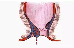 注意了！不是所有的痔疮都会便血！