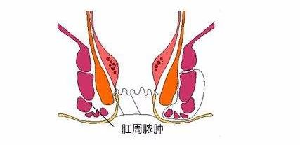 屁股痛？5个肛肠问题会让肛门“受罪”