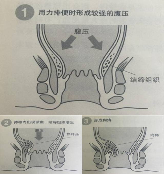 痔疮到底能不能治好