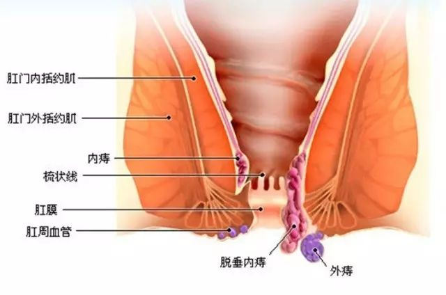 痔疮到底能不能治好