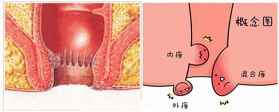 痔疮可不可以不去治疗？