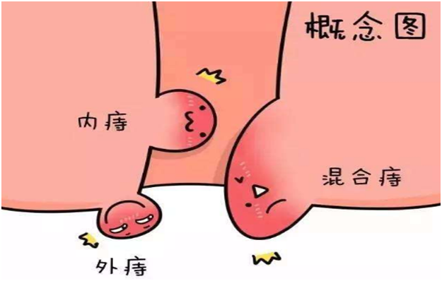 “痔疮”千万不能拖！教你5点预防