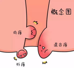 痔疮、便血不要慌，掌握这个方法轻松除痔疮！
