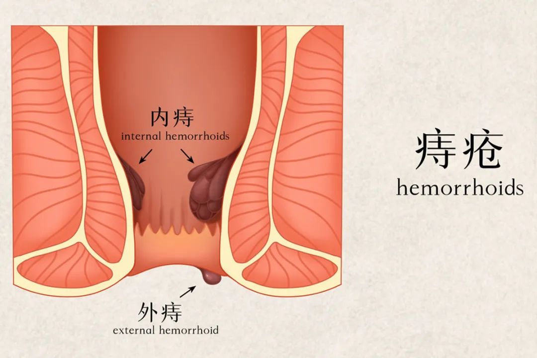 关于痔疮，这些误区你一定要知道