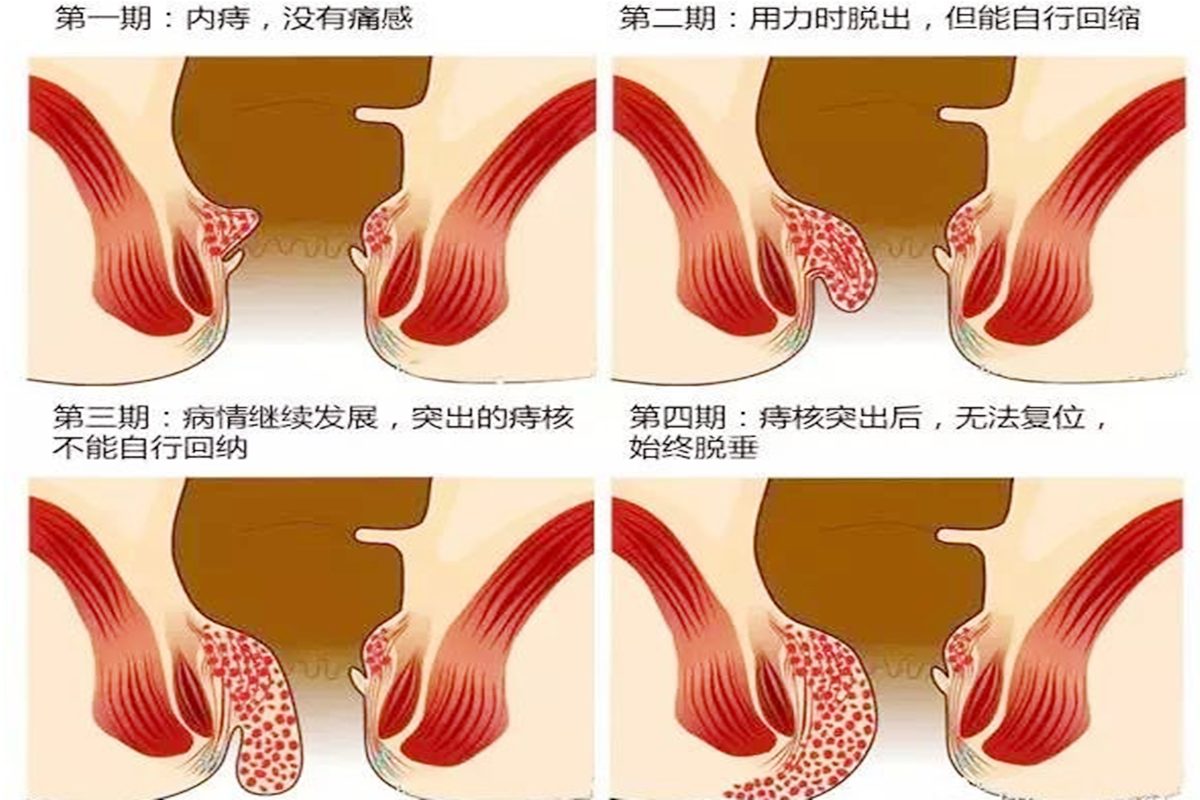 关于痔疮，这些误区你一定要知道